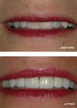 Before and After Teeth