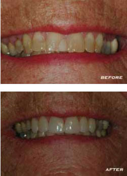 Before and After Teeth