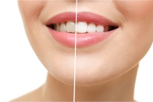 Smiling woman with teeth whitening result